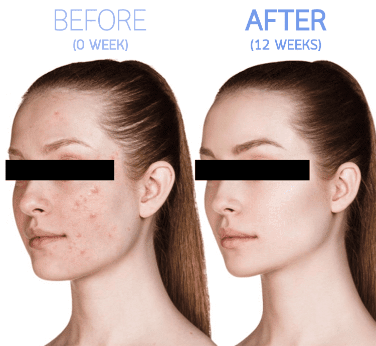Face Skin Control is very good for curing acne.